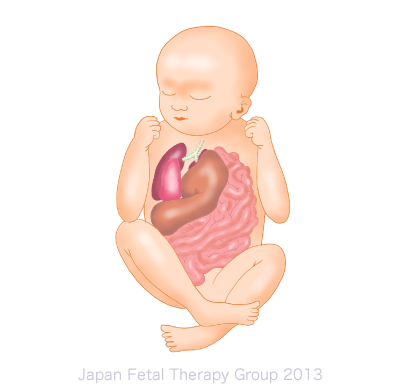 先天性横隔膜ヘルニア 日本胎児治療グループ